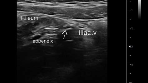 pediatric normal appendix ultrasonography소아정상충수초음파 - YouTube