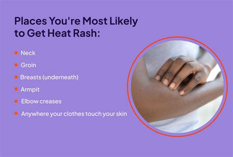 Heat Rash: Signs, Duration, and Treatment