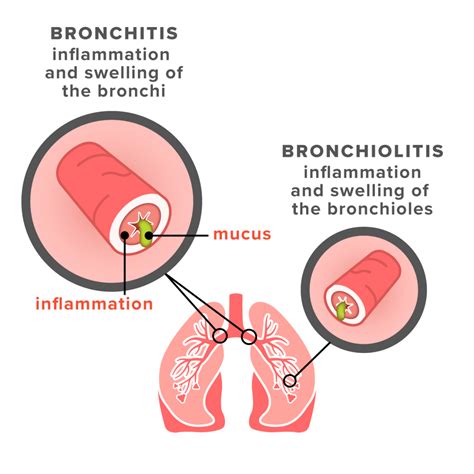 How To Prevent Bronchiolitis - Killexhibition Doralutz