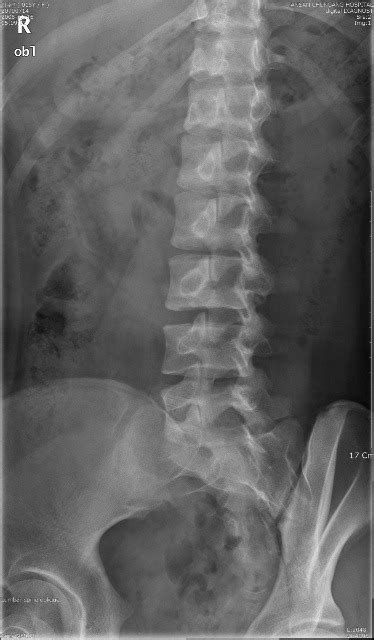 Oblique Lumbar Spine Diagram | Quizlet