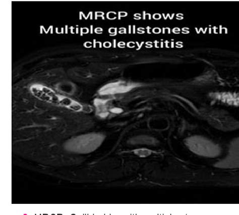 [PDF] Gallstone and Gallstone Related Complications in Pregnant and ...