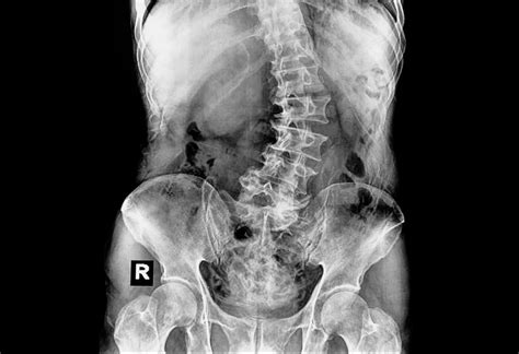 Spina Bifida - Causes, Signs & Treatment