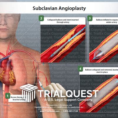 Medical Legal Exhibits - Legal Animations & Trial Graphics - Tria...