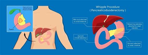 Pancreas Surgery In Singapore | LS Lee Surgery Clinic