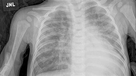 COPD X-Ray: Pictures, Diagnosis, and More