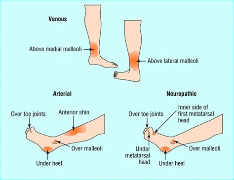 venous and arterial ulcers | Wound care nursing, Medical knowledge, Wounds nursing