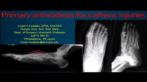 Lisfranc dislocations - ORIF vs fusion - Debate - YouTube