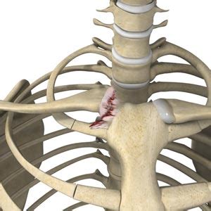 Sternoclavicular Joint Injury | South County Orthopedic Specialists ...