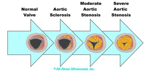 Aortic Stenosis Progression 5 Facts Patients Should K - vrogue.co