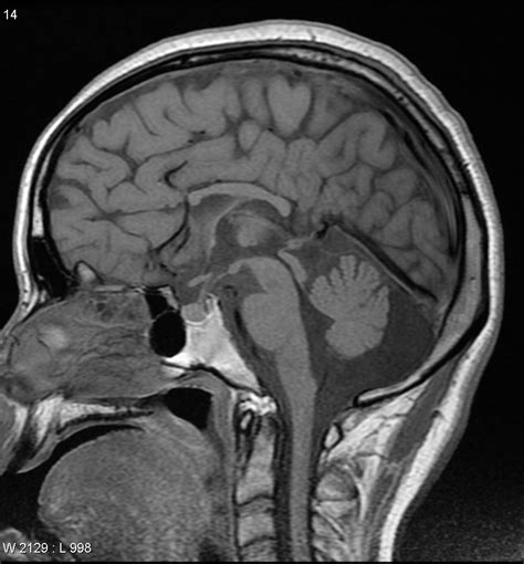 Aicardi syndrome | Image | Radiopaedia.org