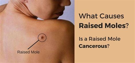 Raised Mole: Is It Cancerous? All You Need to know About Raised Moles