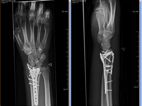 Wrist Fracture Surgery | GlobeHealer