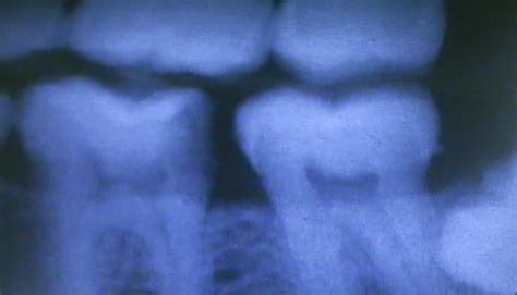 Tooth Pulp Infection - III.3 – The Center for Dental Education