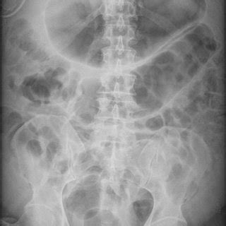 Postoperative ileus following thoracoscopic right upper lobe resection.... | Download Scientific ...