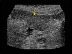 Omental cake and ascites | Ultrasound, Abdomen, Case