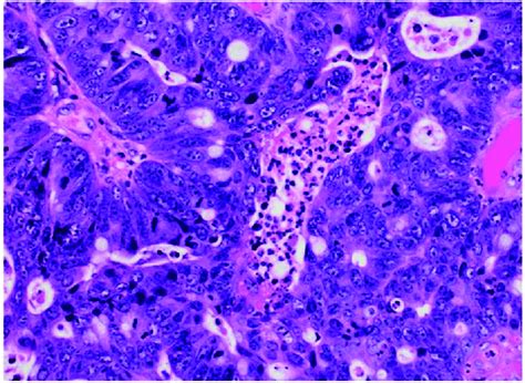 Pathology of the sigmoid colon polyp showing moderately differentiated ...