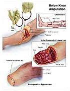 Below Knee Amputation Medical Illustration Medivisuals