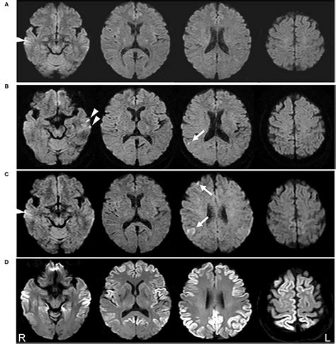 Frontiers | Case Report: Extremely Early Detection of Preclinical ...