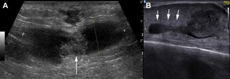 Primary Care Management of Skin Abscesses Guided by Ultrasound - The ...