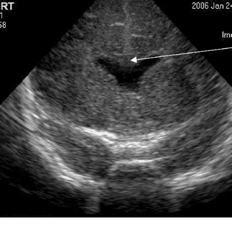 Figure 1 from Absence of Cavum Septum Pellucidum Related With Optic ...