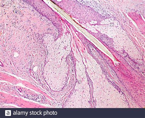 Pilosebaceous unit hi-res stock photography and images - Alamy