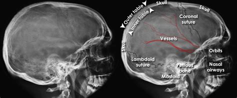 Trauma X-ray - Axial skeleton - Skull