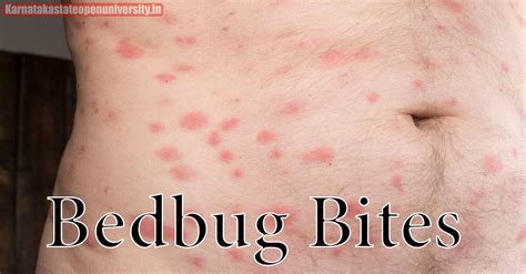 Bedbug Bites Pictures, Causes, Symptoms, Treatment and Prevention