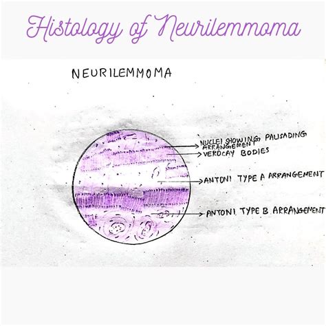 Premieka Muthukumar on LinkedIn: #neurilemmoma #schwanoma #histology # ...