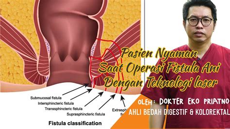 Sembuh Dari Fistula Ani Berkat Operasi Dengan Tehnologi Laser FILAC ...