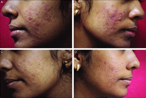 Erythematous acne scars (grade 3) with few active acne lesions. (A and ...