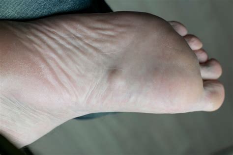 Plantar Fibroma Treatment: Alleviating Foot Pain Reliably