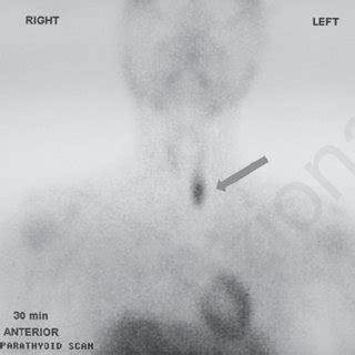 m Tc sestamibi parathyroid scan showing left inferior parathyroid adenoma. | Download Scientific ...