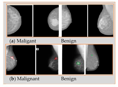 Breast Tissue Identification In Digital Mammogram Usi - vrogue.co