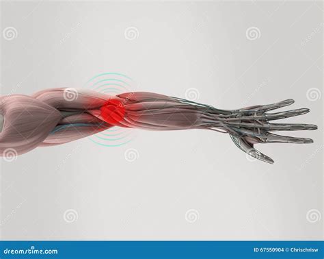 Anatomy Model Showing Elbow Pain. Stock Illustration - Illustration of color, elbow: 67550904