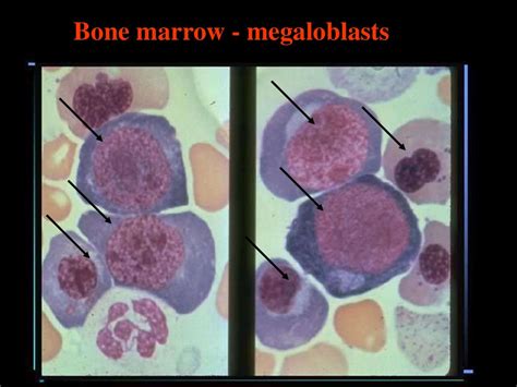 Megaloblastic anemia - online presentation