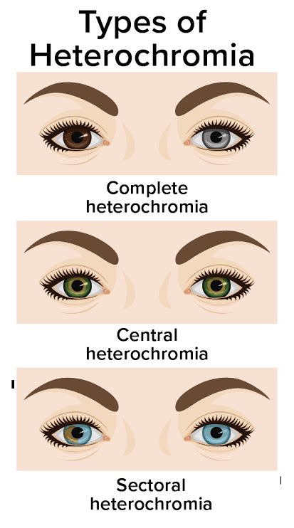 Types of heterochromia - MEDizzy