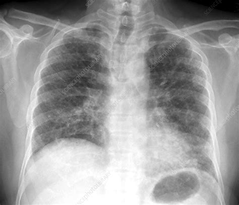 Pulmonary fibrosis, chest X-ray - Stock Image - C038/8809 - Science Photo Library