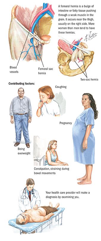 Hernia | Gastroenterology | Spectrum Health