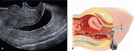 Ectopic Pregnancy | Obgyn Key