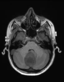 Pilocytic astrocytoma - NeurologyNeeds.com