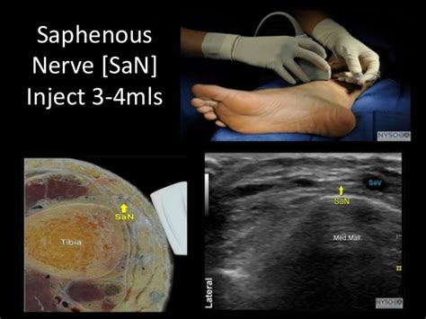 Ultrasound Guided Ankle Block