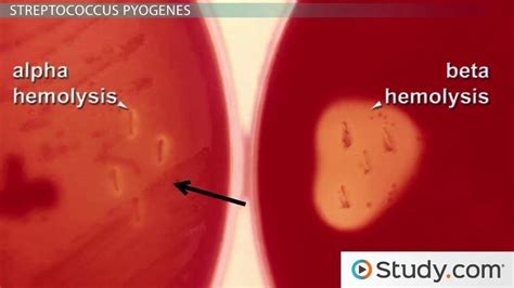 Strep Throat | Definition, Stages & Incubation - Lesson | Study.com