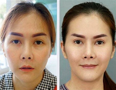 HIFU Facelift Treatment Before And After (7) » Facelift: Info, Prices, Photos, Reviews, Q&A