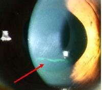 The red arrow indicates vertical ridges parallel two of the cone... | Download Scientific Diagram