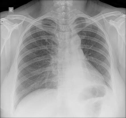 Bronchial carcinoid | Radiology Case | Radiopaedia.org