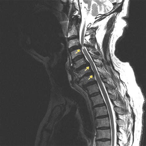 Spinal Cord Compression (Suspected)