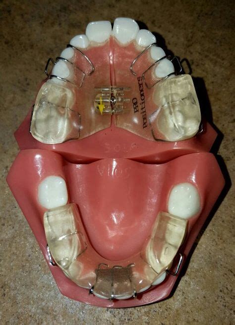 19 Orthodontics Appliances ideas | orthodontics, dental, appliances