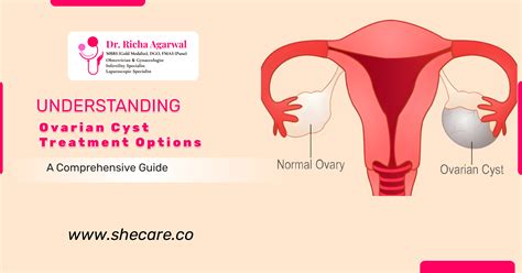 Navigating Ovarian Cyst Treatment: A Comprehensive Guide To Options And ...