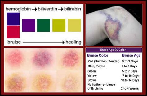 Bruises: The Secret Behind The Rainbow of Colors - Complete Wellness Report
