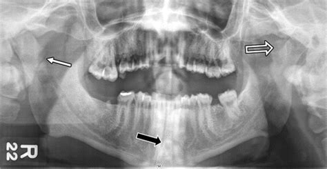 Mandibular Fracture X Ray